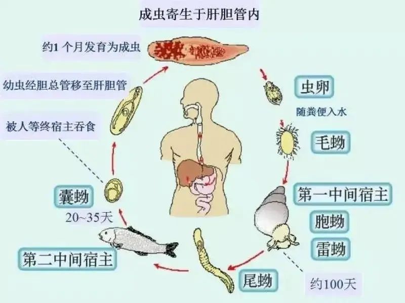 男子生食腌制食物致胆道感染七条虫，预防与应对指南