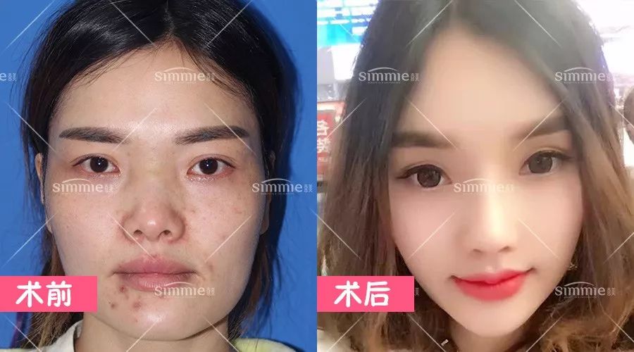 最新脸部填充技术，重塑容颜的科学与艺术探索